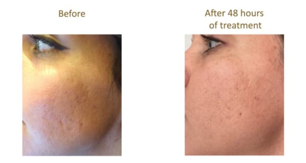 tucson Aquagold Acne Scar Treatment before and after photos