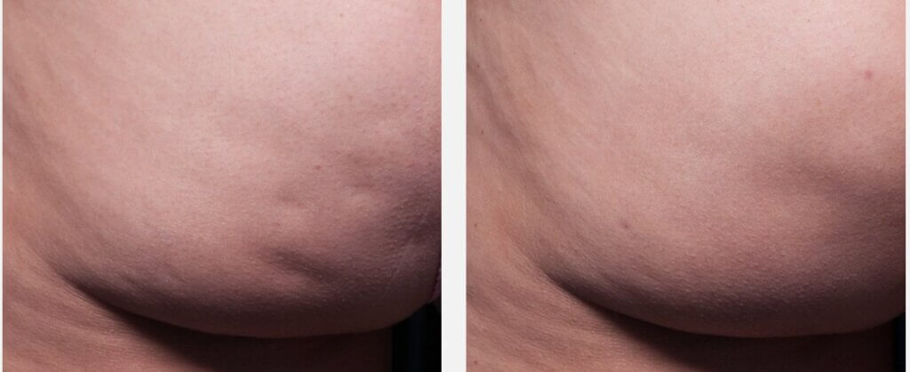 tucson patient before and after cellfina cellulite treatment