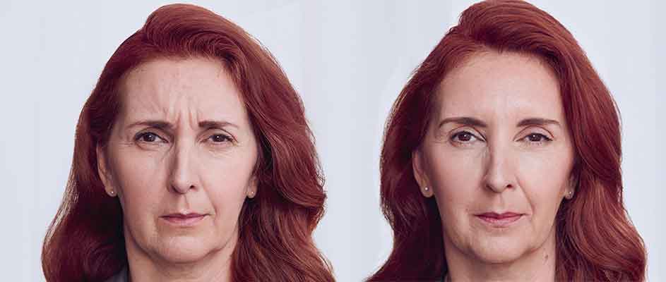 tucson woman before and after receiving Botox on face