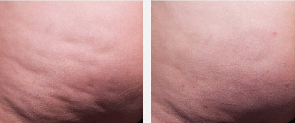 tucson patient before and after cellfina cellulite treatment