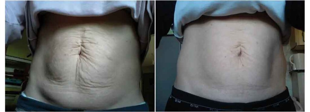 tucson patient before and after Endymed laser skin tightening treatment on stomach