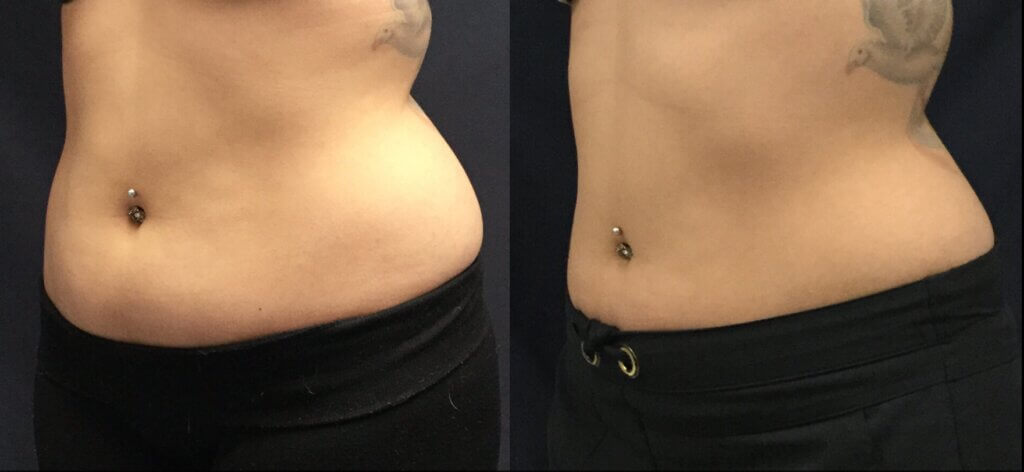 tucson sculpsure laser sculpting before and after photos