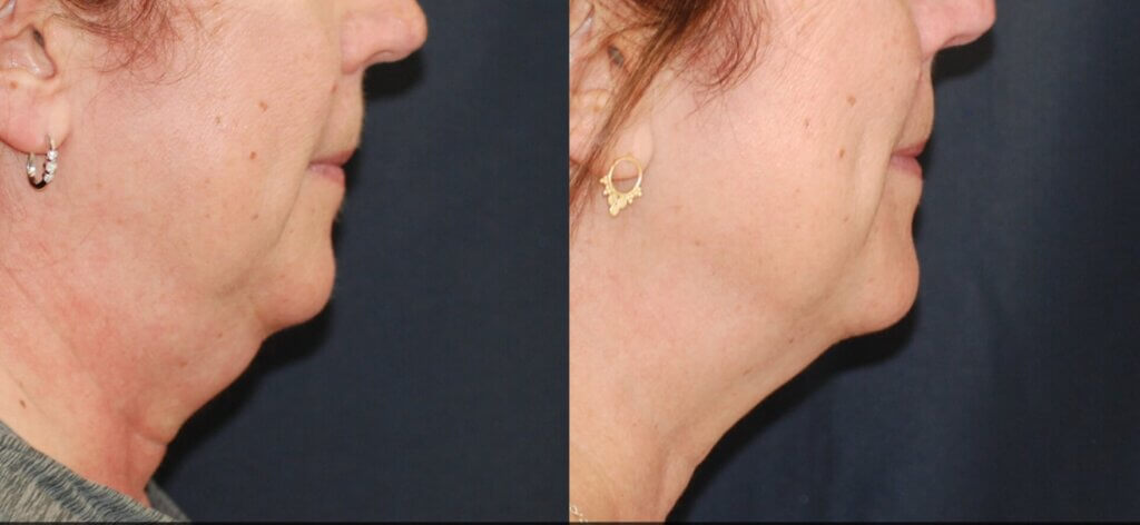 tuscon woman before and after sculpsure treatment on double chin
