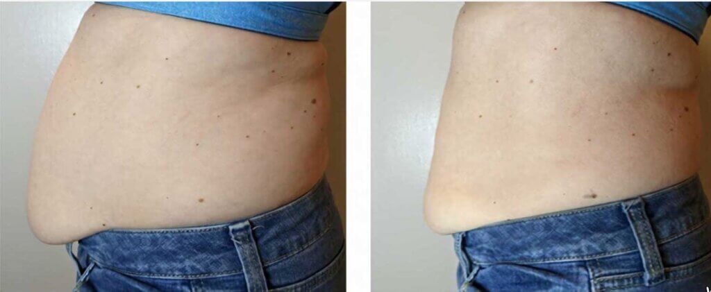 Tucson woman before and after body contour treatment on stomach