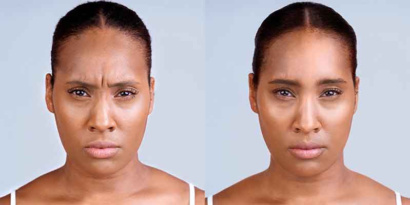 tuscon woman before and after Xeomin skin smoothing treatment on face