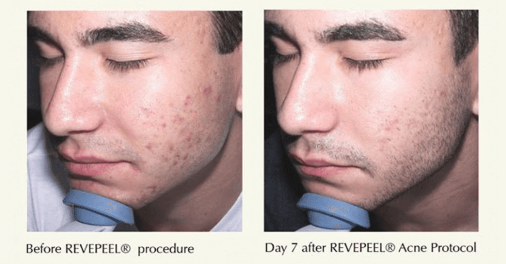 tucson man before and after revepeel procedure