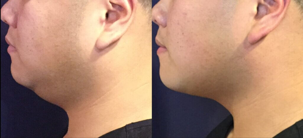 tucson man before and after sculpsure treatment on double chin