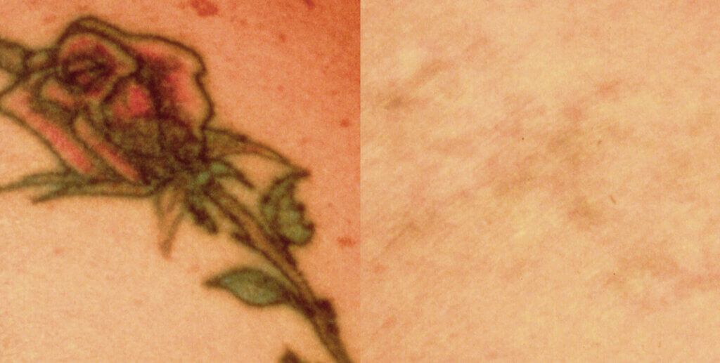rose tattoo before and after laser tattoo removal