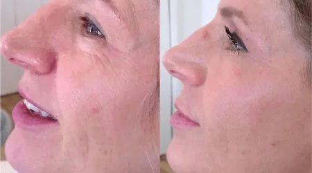 tucson woman plasma pen eye lift treatment before and after