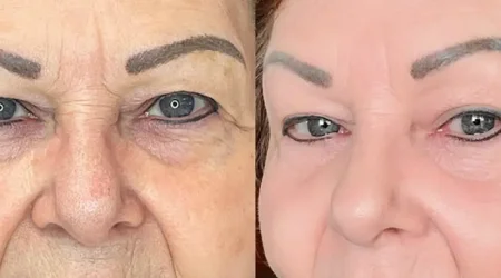 tucson woman plasma pen before and after photos