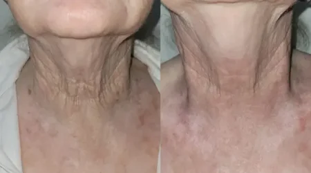 tucson woman plasma pen before and after photos